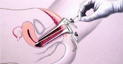 What is a Pap Smear Test for Women? And Which Age is Good for a Pap Smear?