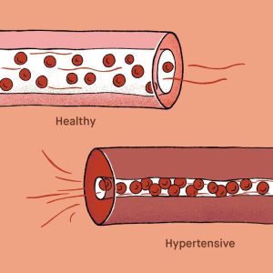Struggling with high blood pressure? Learn causes, risks, and treatment options from Dr. Vinay Bhomia, MD Physician at Sanjivani Hospital, Vastrapur.