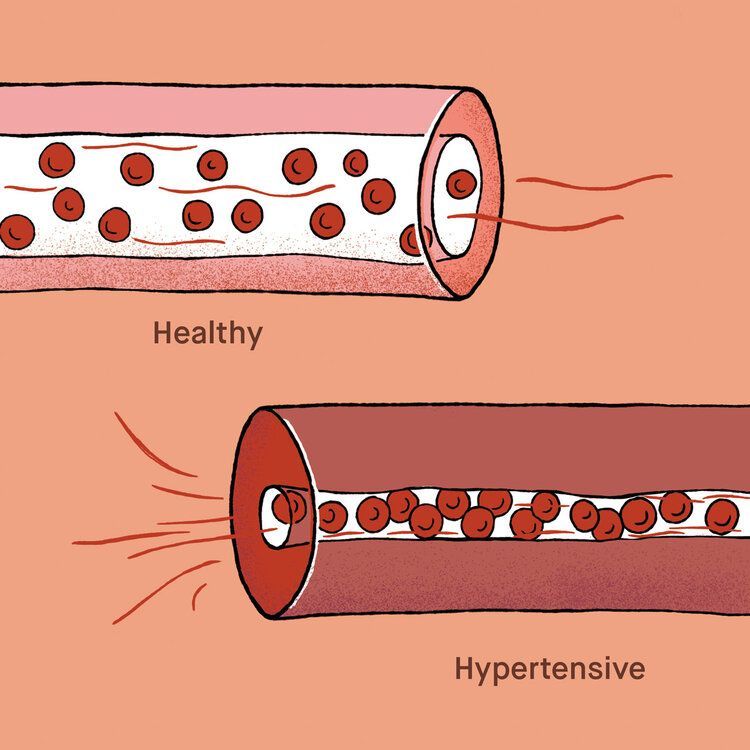 Struggling with high blood pressure? Learn causes, risks, and treatment options from Dr. Vinay Bhomia, MD Physician at Sanjivani Hospital, Vastrapur.
